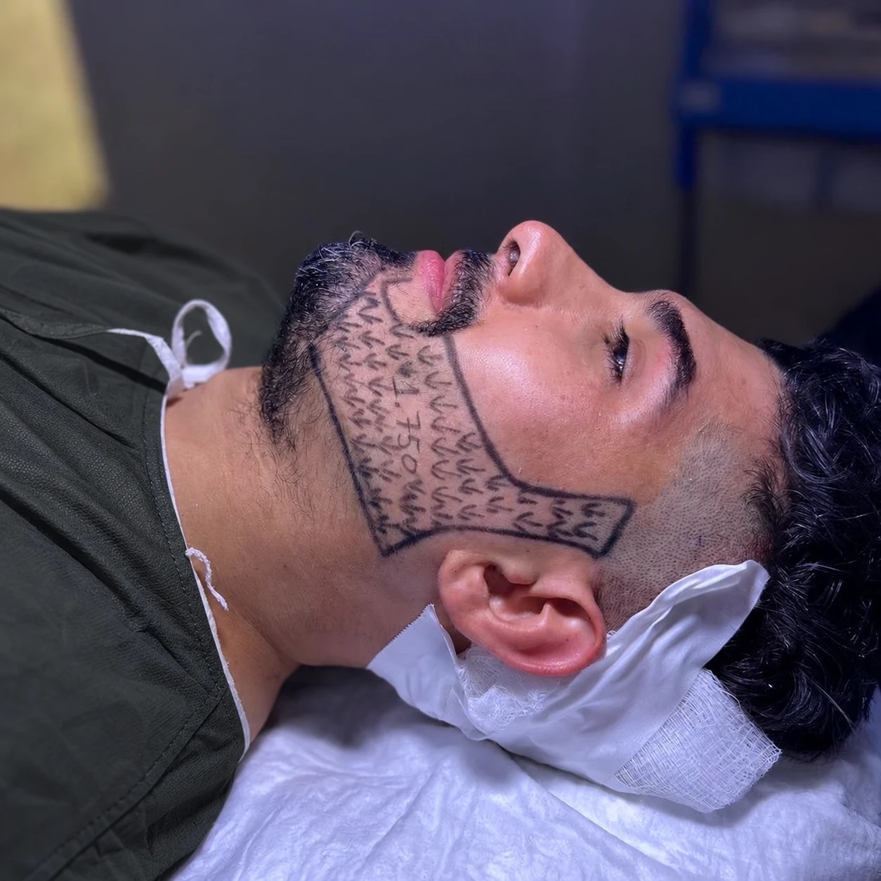 Beard transplant design at OZEL Istanbul: the beard area drawn on the cheek and jawline, with marks showing the downward direction of every hair, planned for 1,750 grafts