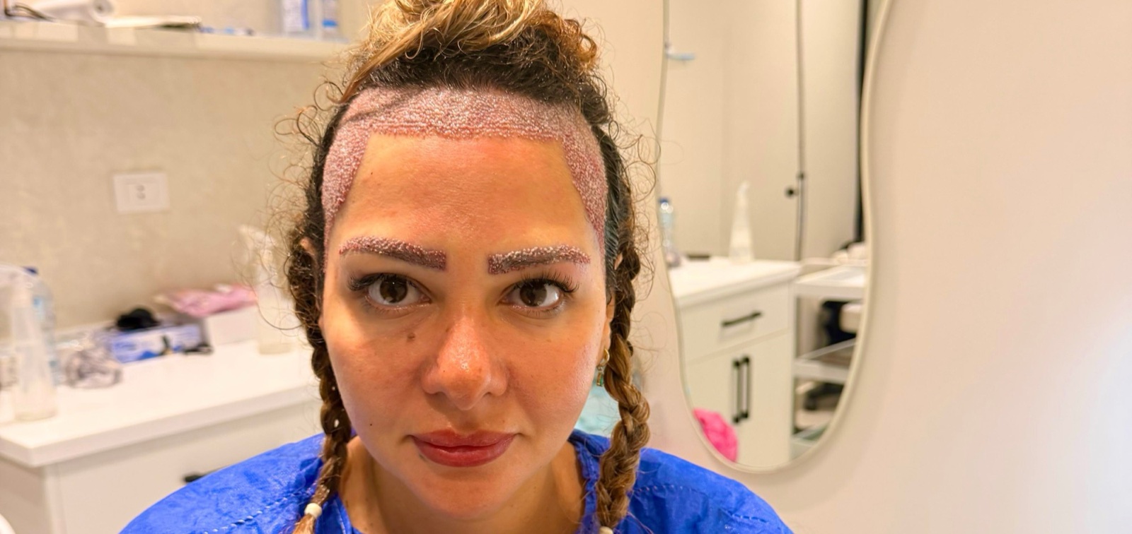 Front view right after an eyebrow transplant at OZEL, showing both eyebrows matched in shape and height