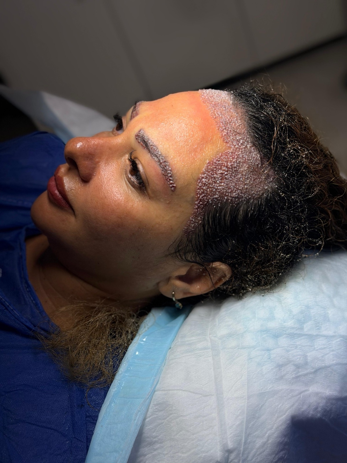 A woman right after an eyebrow transplant and hairline transplant at OZEL, every graft placed in a controlled direction along the eyebrow