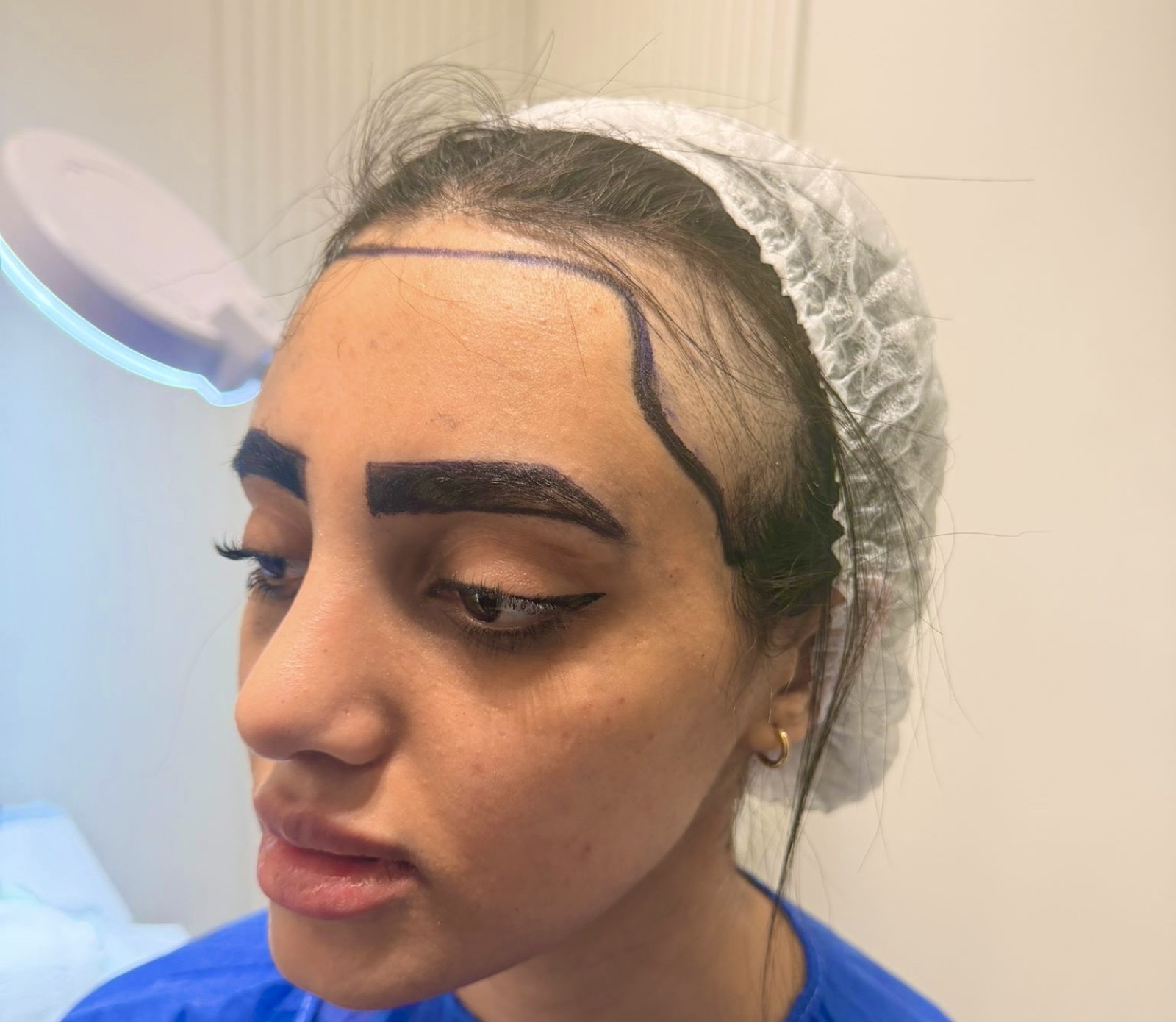 Eyebrow design at OZEL: the new eyebrow drawn on a woman’s face to follow the shape of her eye, together with her new hairline