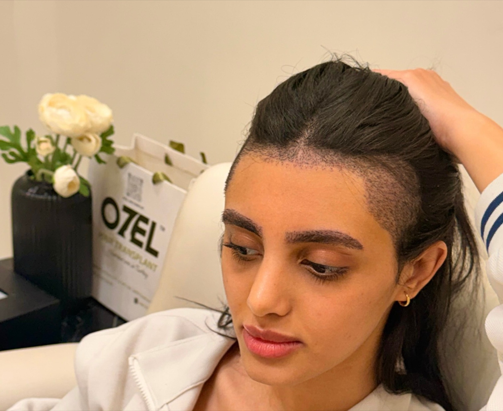 Natural eyebrows after an eyebrow transplant at OZEL Hair Transplant Istanbul, shown in profile with the hair lying flat