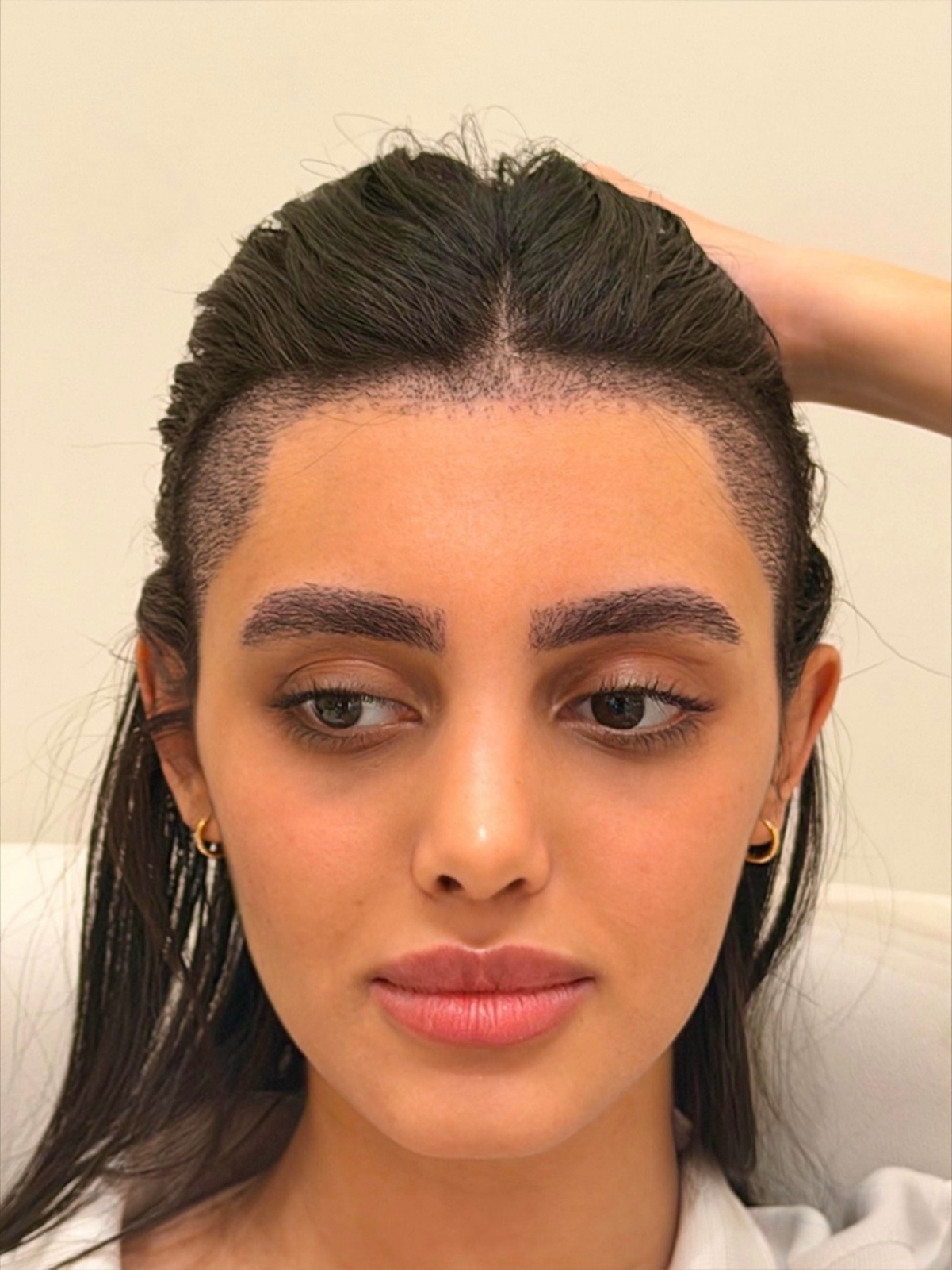 Eyebrow transplant result at OZEL Istanbul: natural, symmetrical eyebrows that follow the shape of the eyes, with every hair lying flat