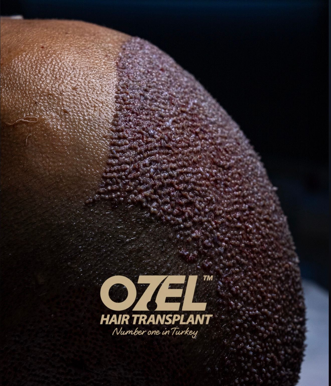 لقطة قريبة لبصيلات مزروعة حديثًا متقاربة جدًا عند OZEL Hair Transplant