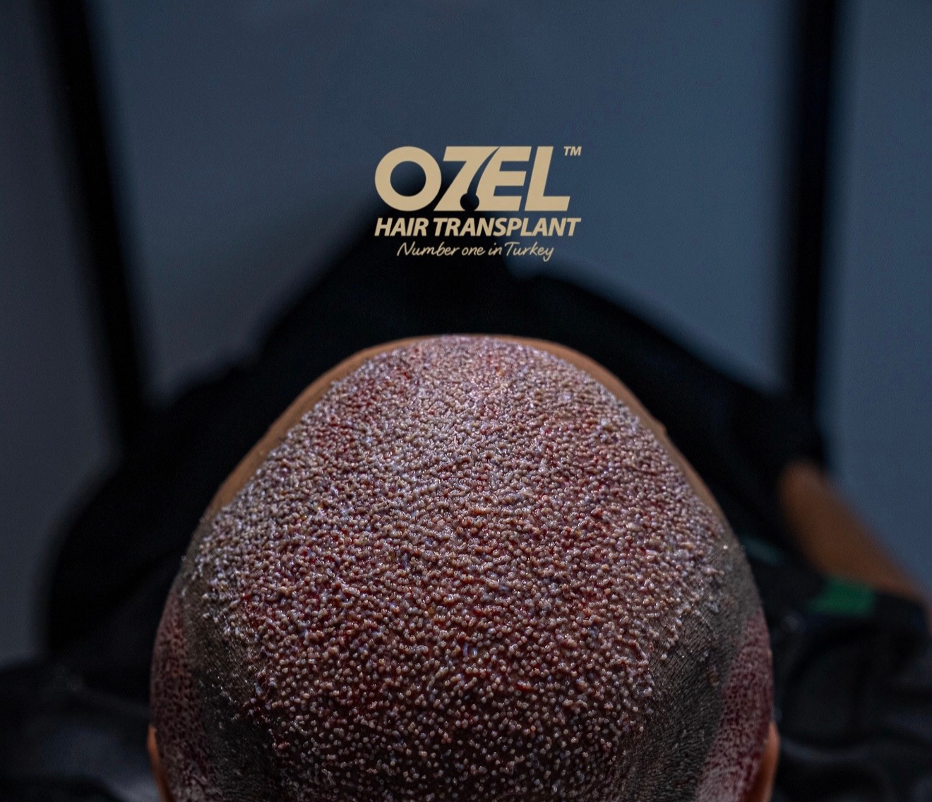 رأس مراجع من الأعلى بعد الزراعة تظهر فيه بصيلات متقاربة في OZEL Hair Transplant