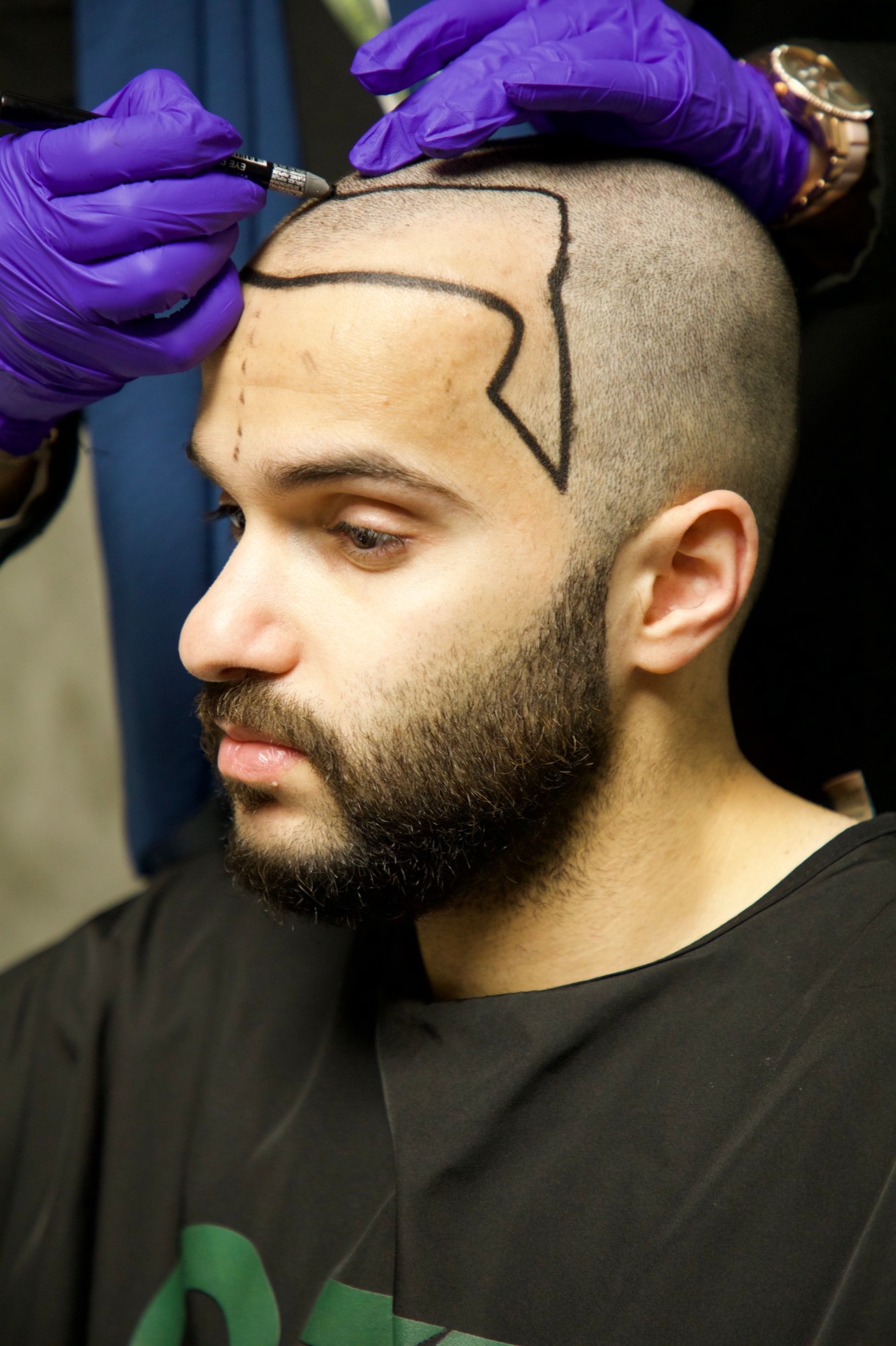 مختصة في OZEL Hair Transplant ترسم خط الشعر بالقلم على جبهة مراجع قبل العملية