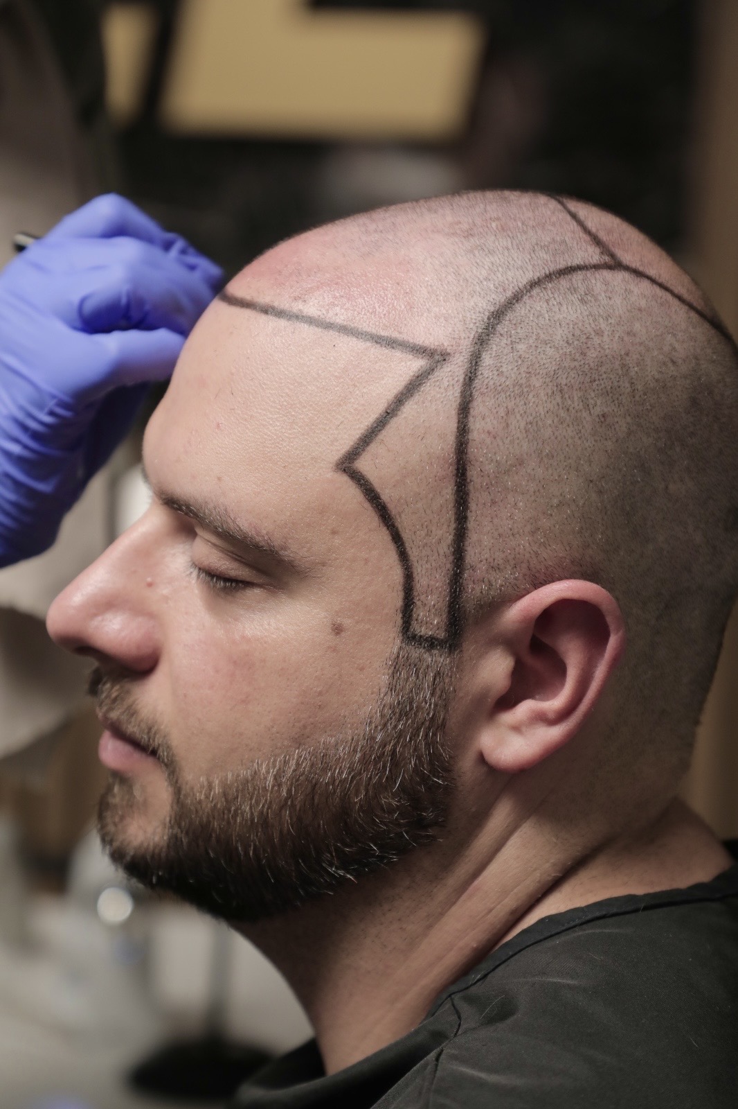A new hairline drawn to follow the client's temples and profile