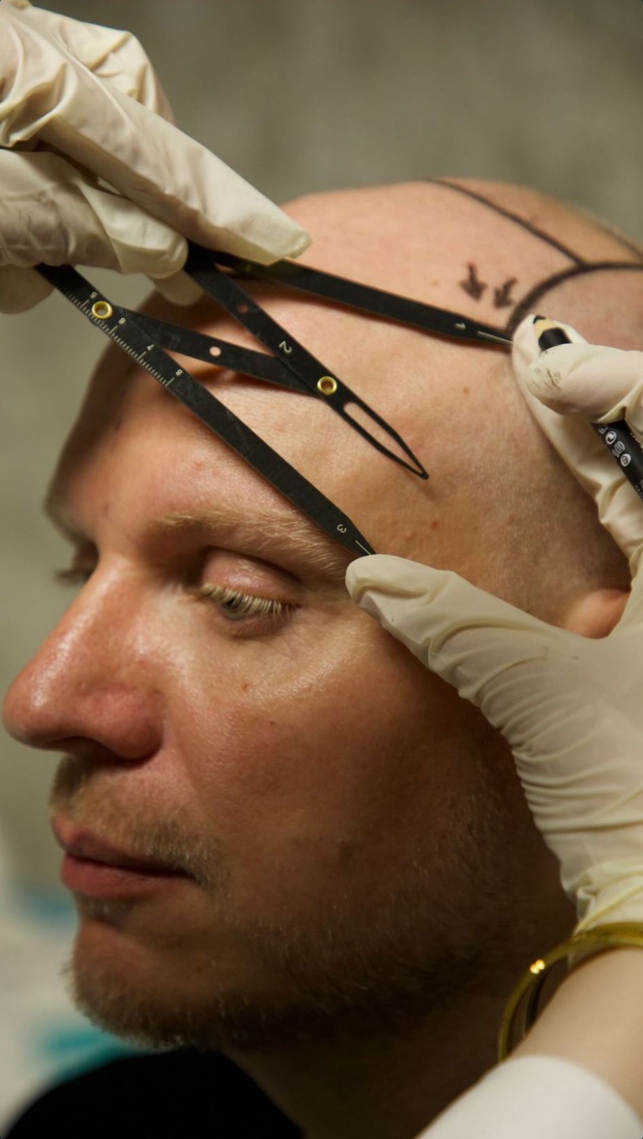Measuring brow-to-hairline proportions with a facial caliper