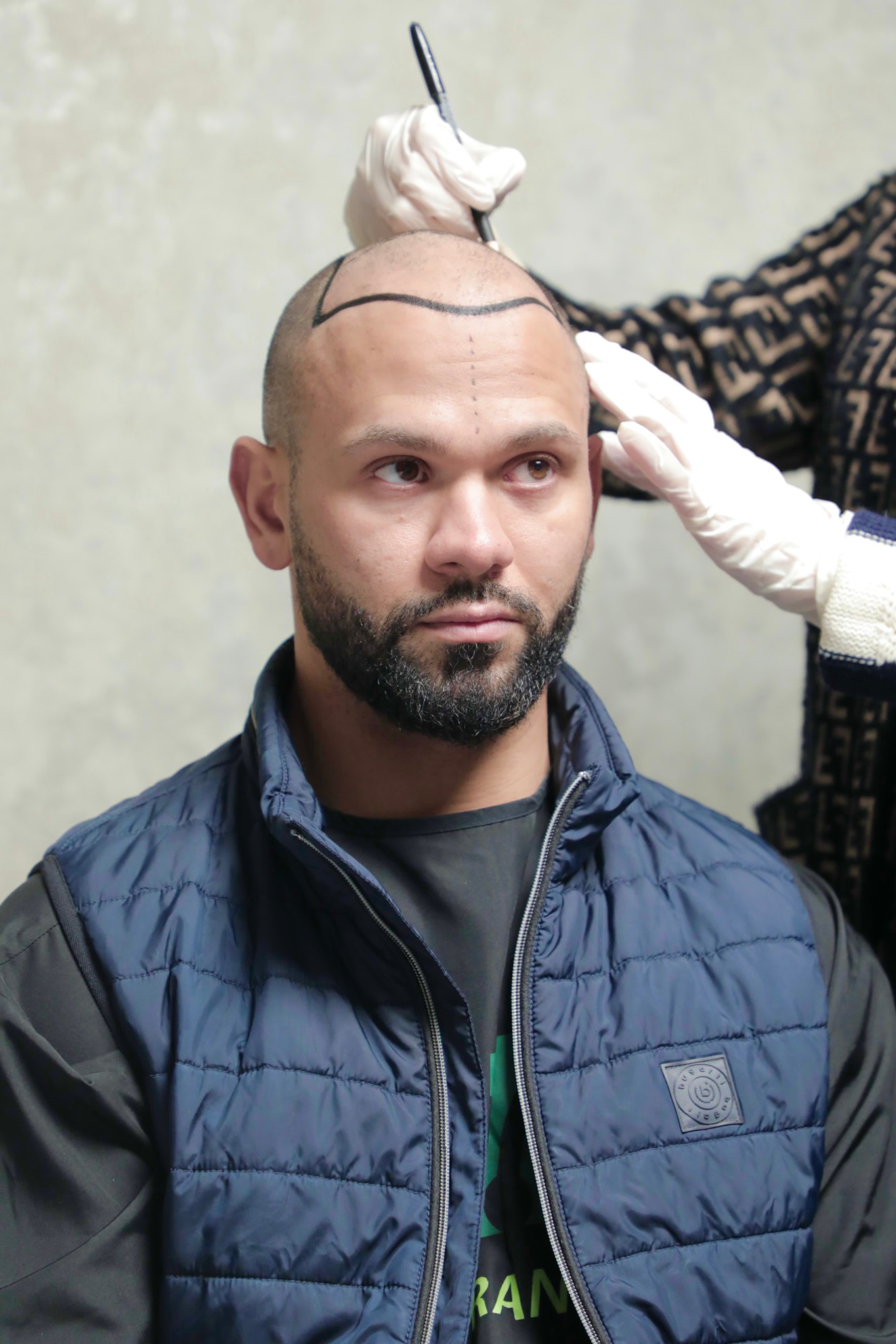 Drawing a new hairline, centred on the client's face