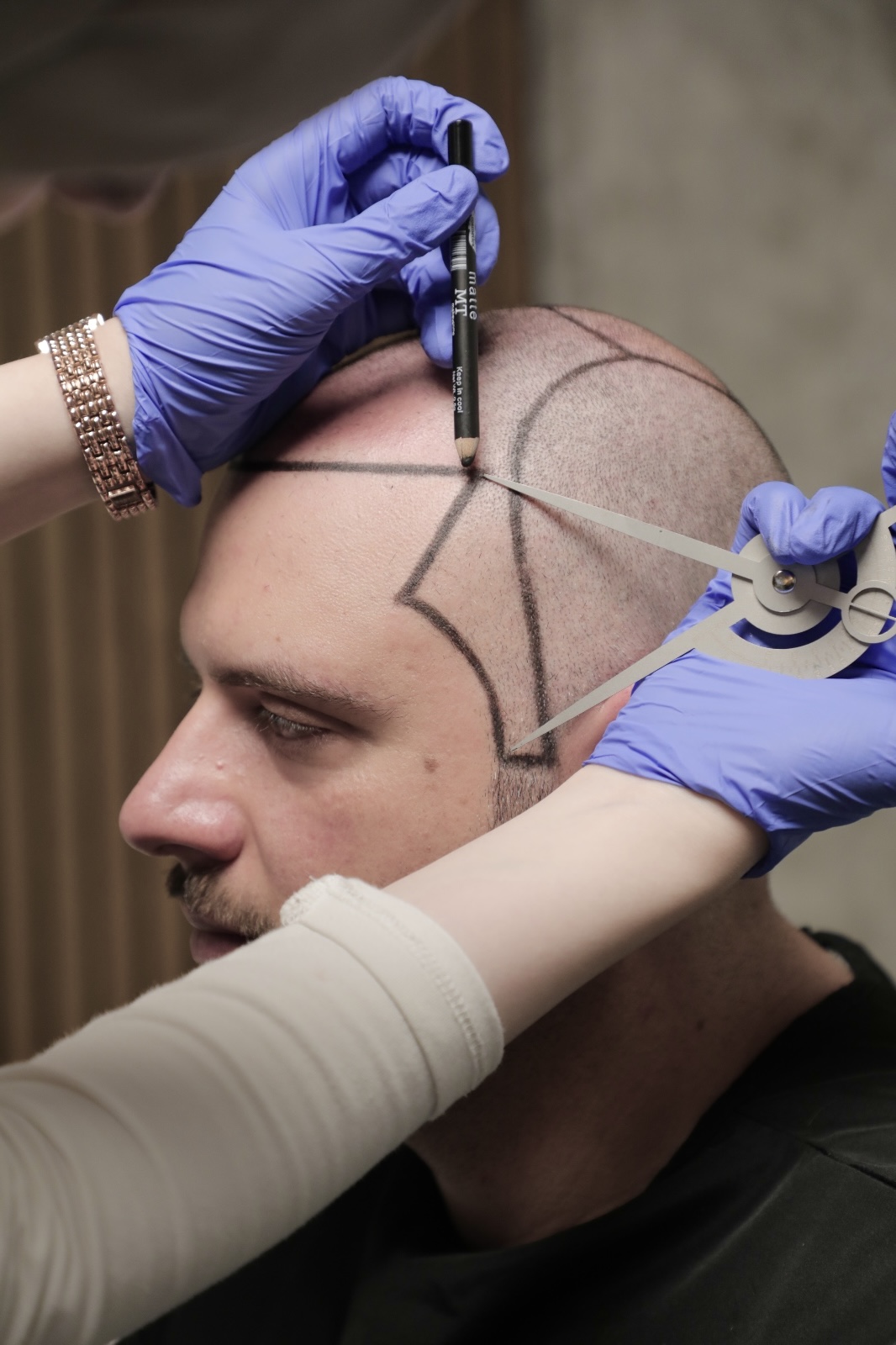 Mapping the hairline with a pencil and facial compass