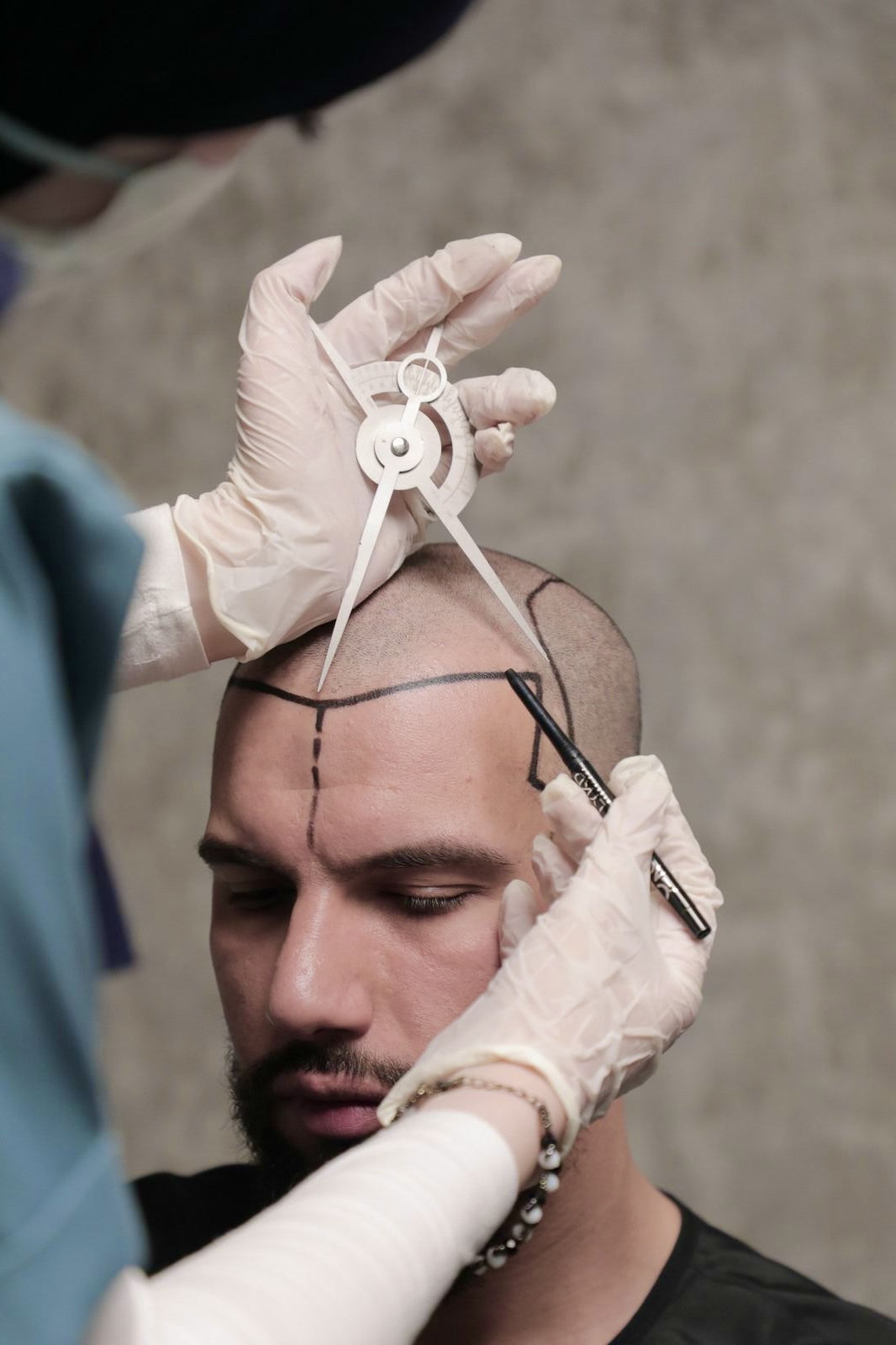 Setting the hairline height with a facial compass