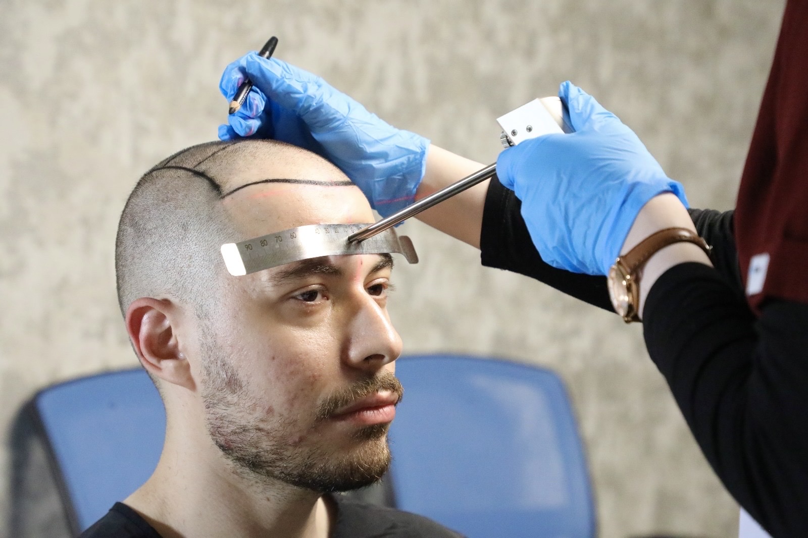 An OZEL doctor measuring a man's new hairline from the brow with a ruler and laser guide
