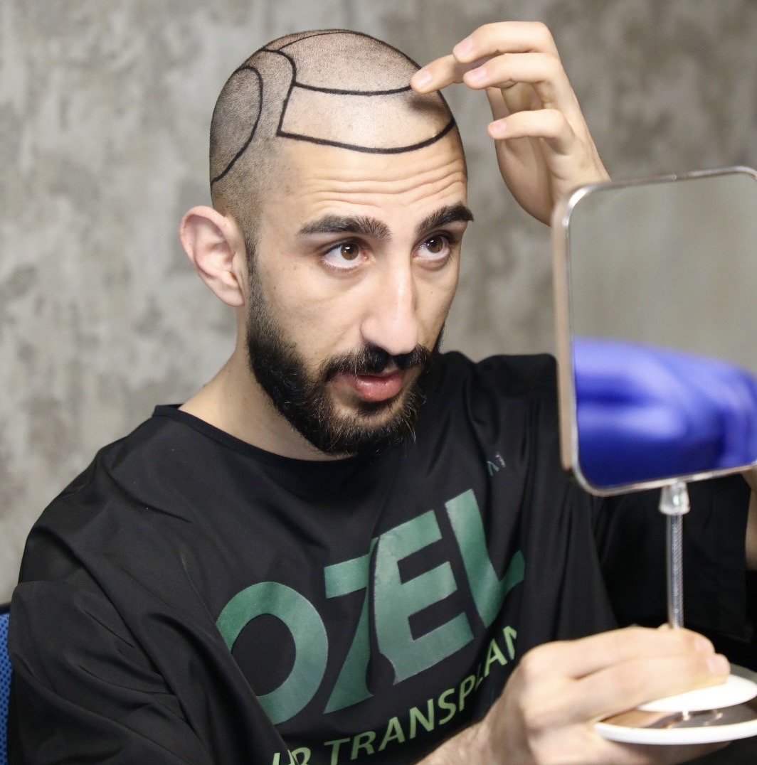 A patient at OZEL Hair Transplant Istanbul checking his newly drawn hairline in a mirror before his hair transplant