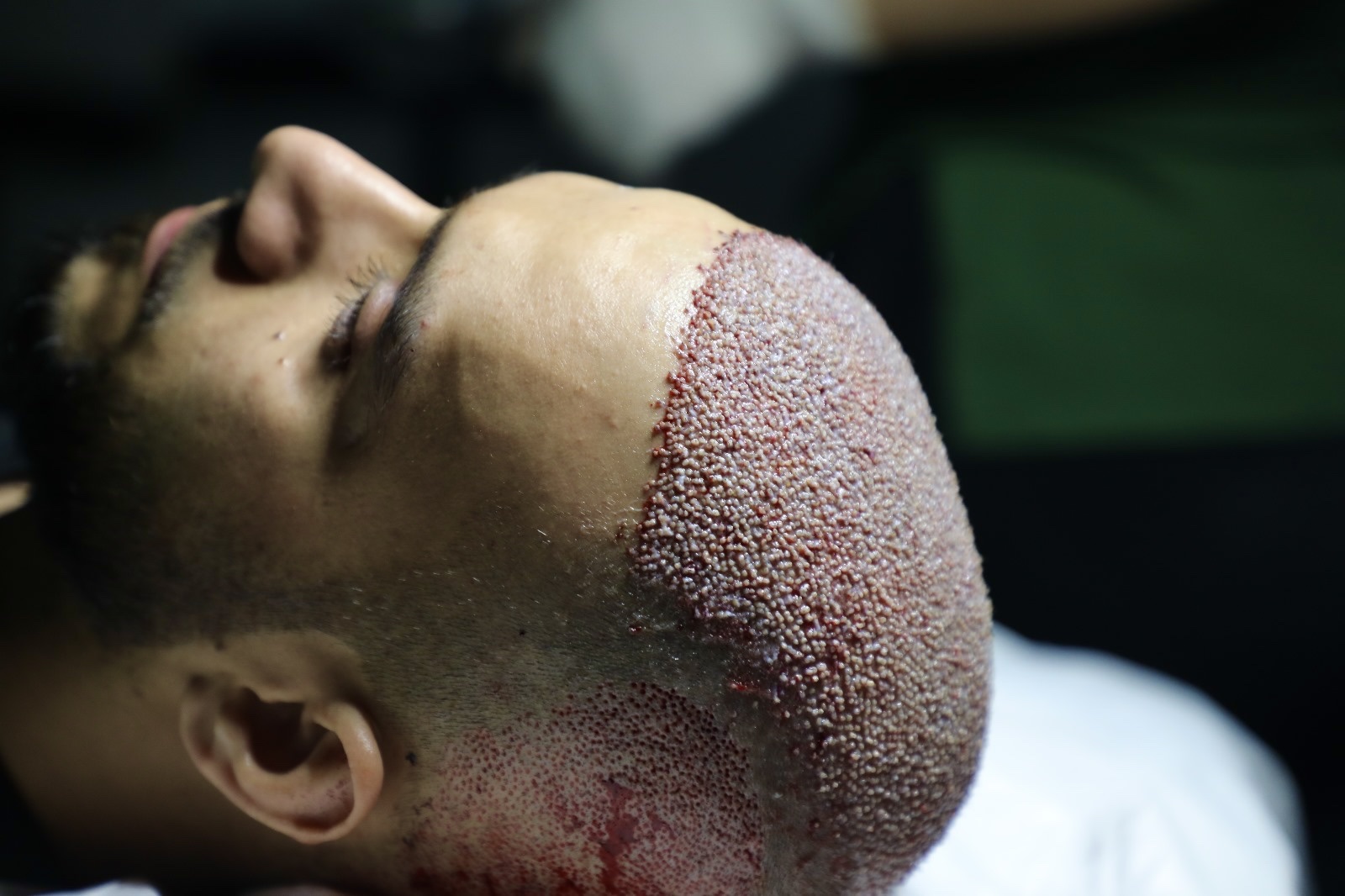 Dense sapphire FUE implantation of a man's hairline and crown right after the procedure