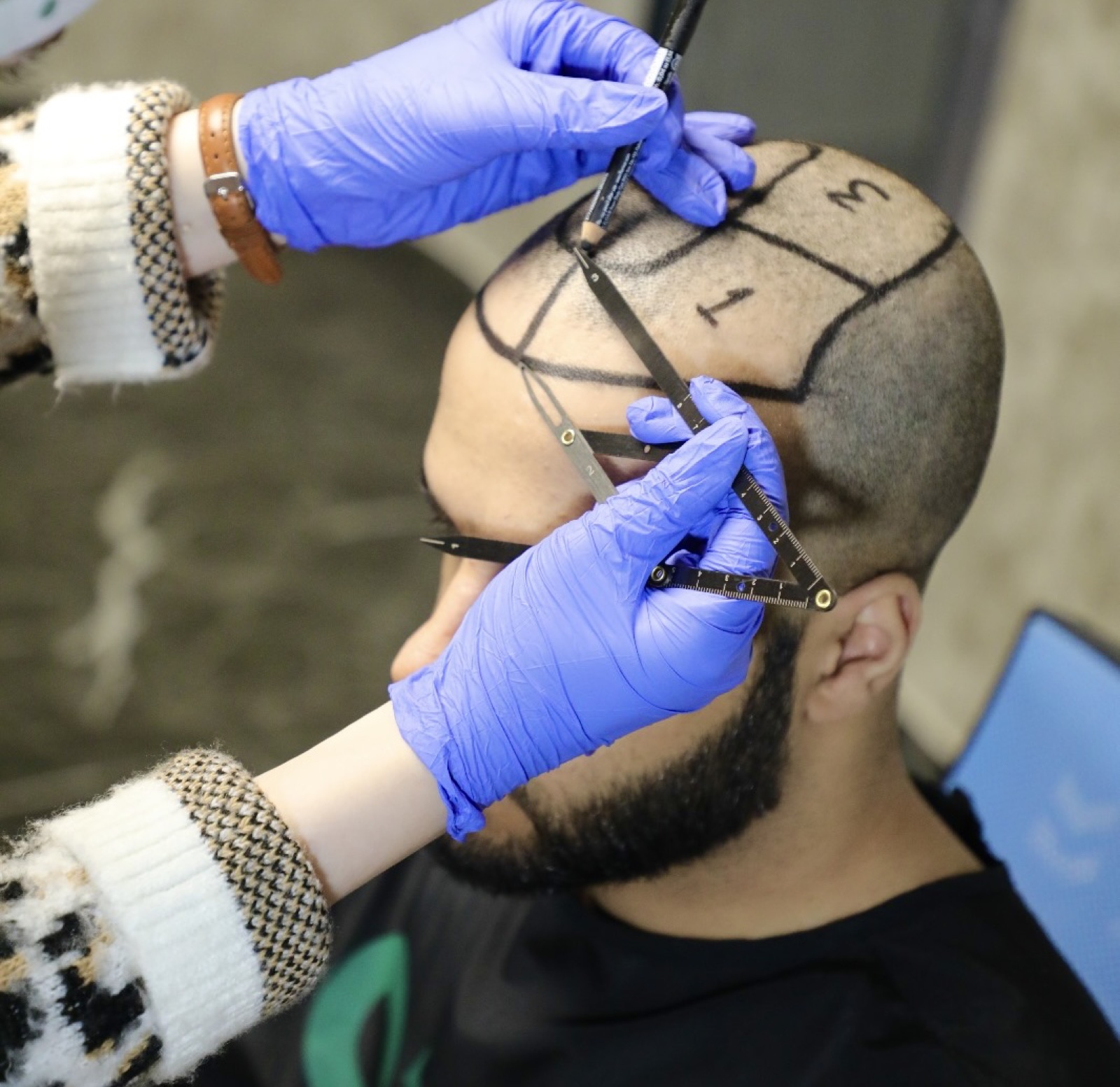 Hair transplant planning at OZEL: the recipient area mapped into numbered zones with a caliper