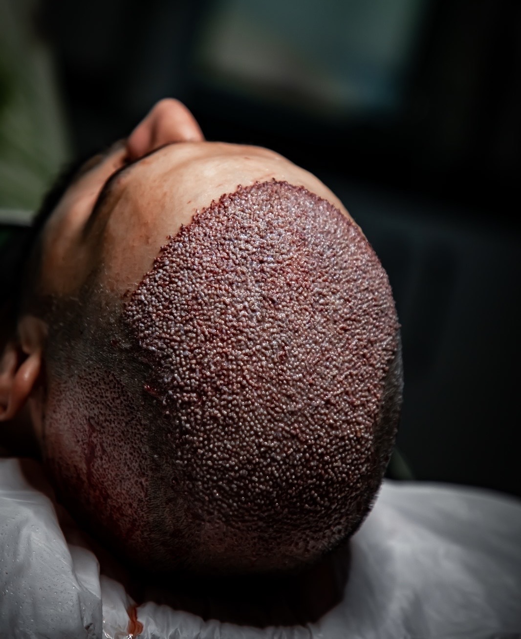 منظر علوي لزراعة شعر كثيفة بتقنية السفير FUE في OZEL بإسطنبول بعد العملية مباشرة، والبصيلات متقاربة في مقدمة الرأس وأعلاه