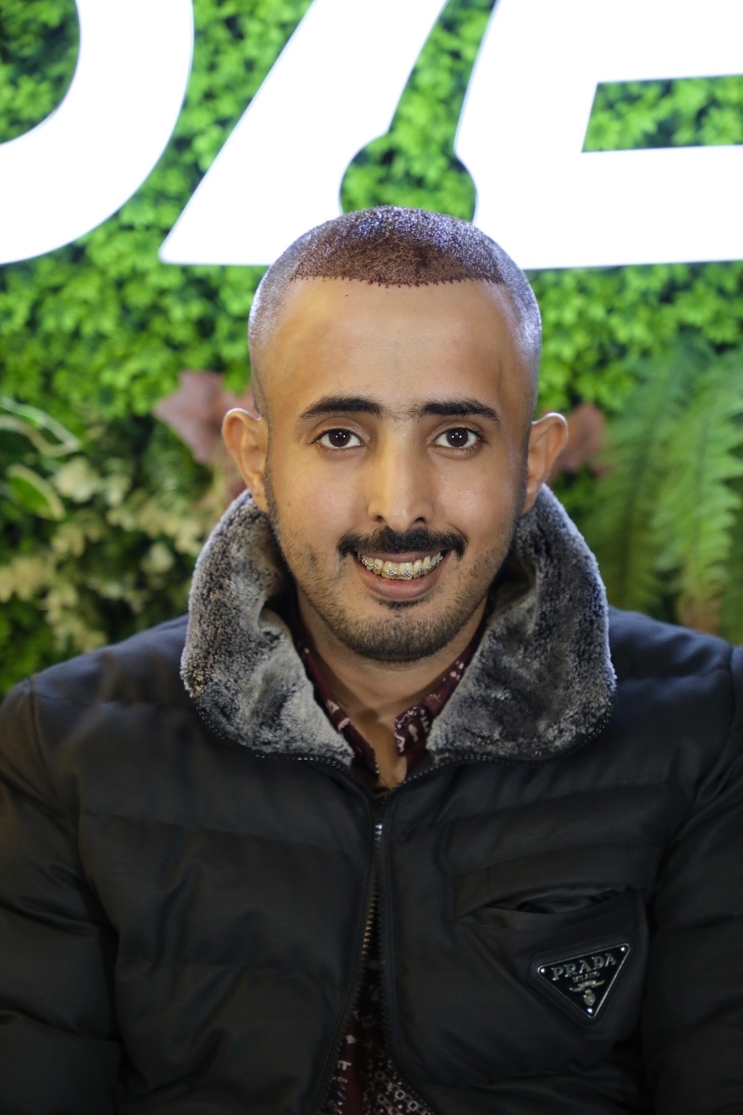 مراجع مبتسم من OZEL في الأيام الأولى بعد زراعة شعره، مع قشور صغيرة على امتداد خط الشعر الجديد، في العيادة بإسطنبول