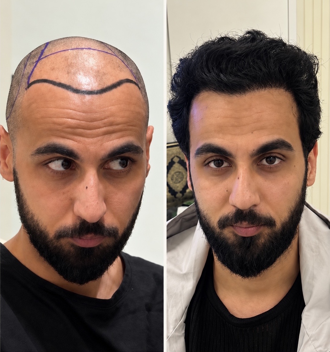 Case 01: before and after hair transplant