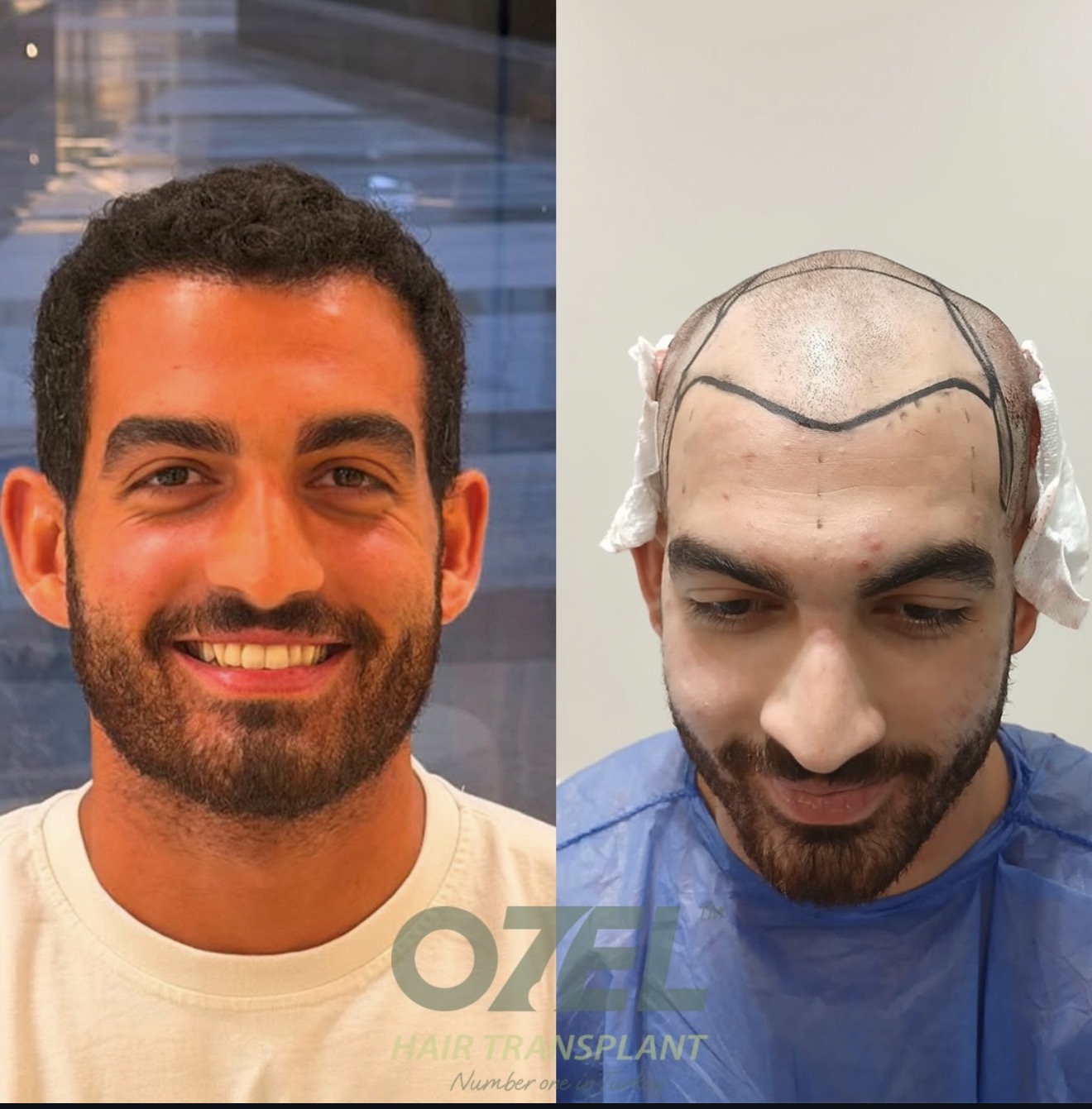 Case 02: before and after hair transplant