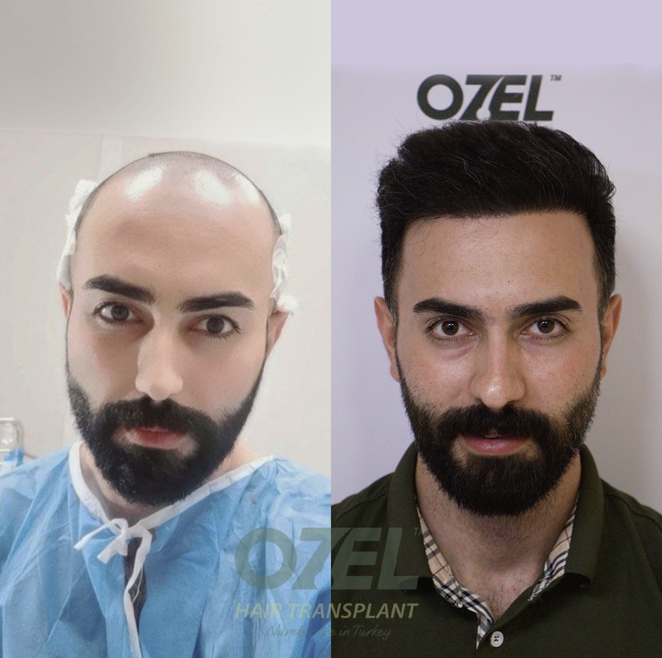 Case 03: before and after hair transplant