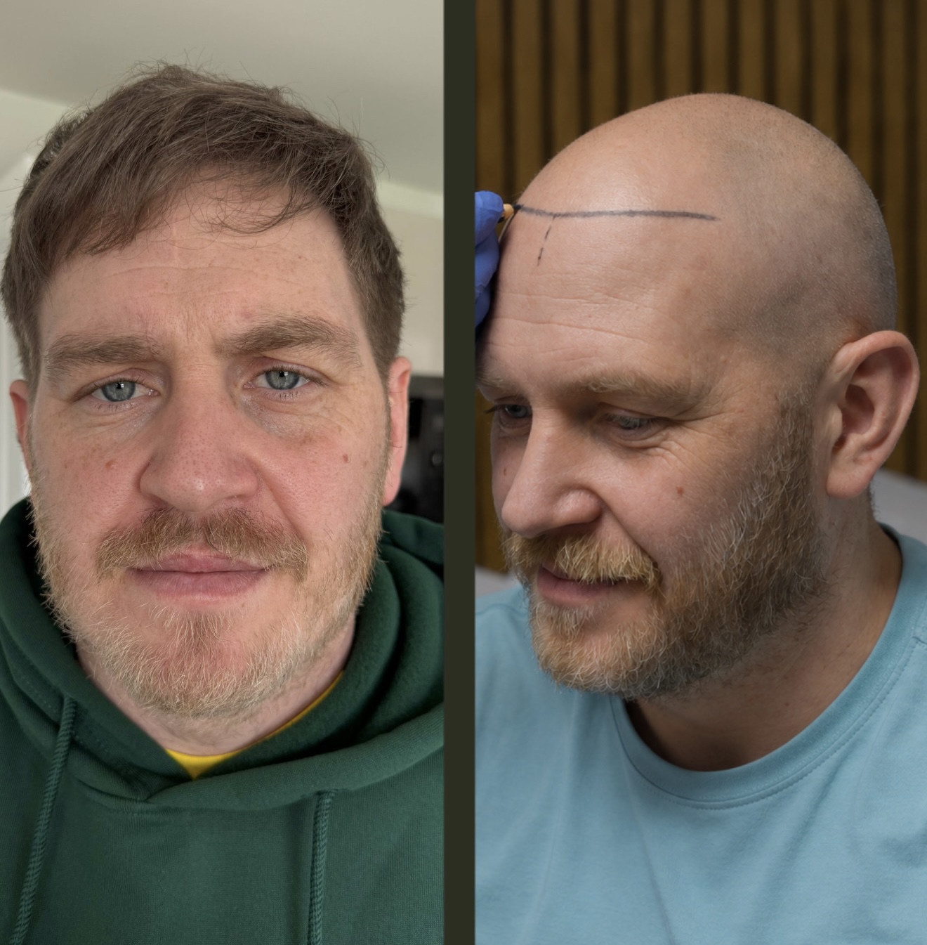 Case 04: before and after hair transplant