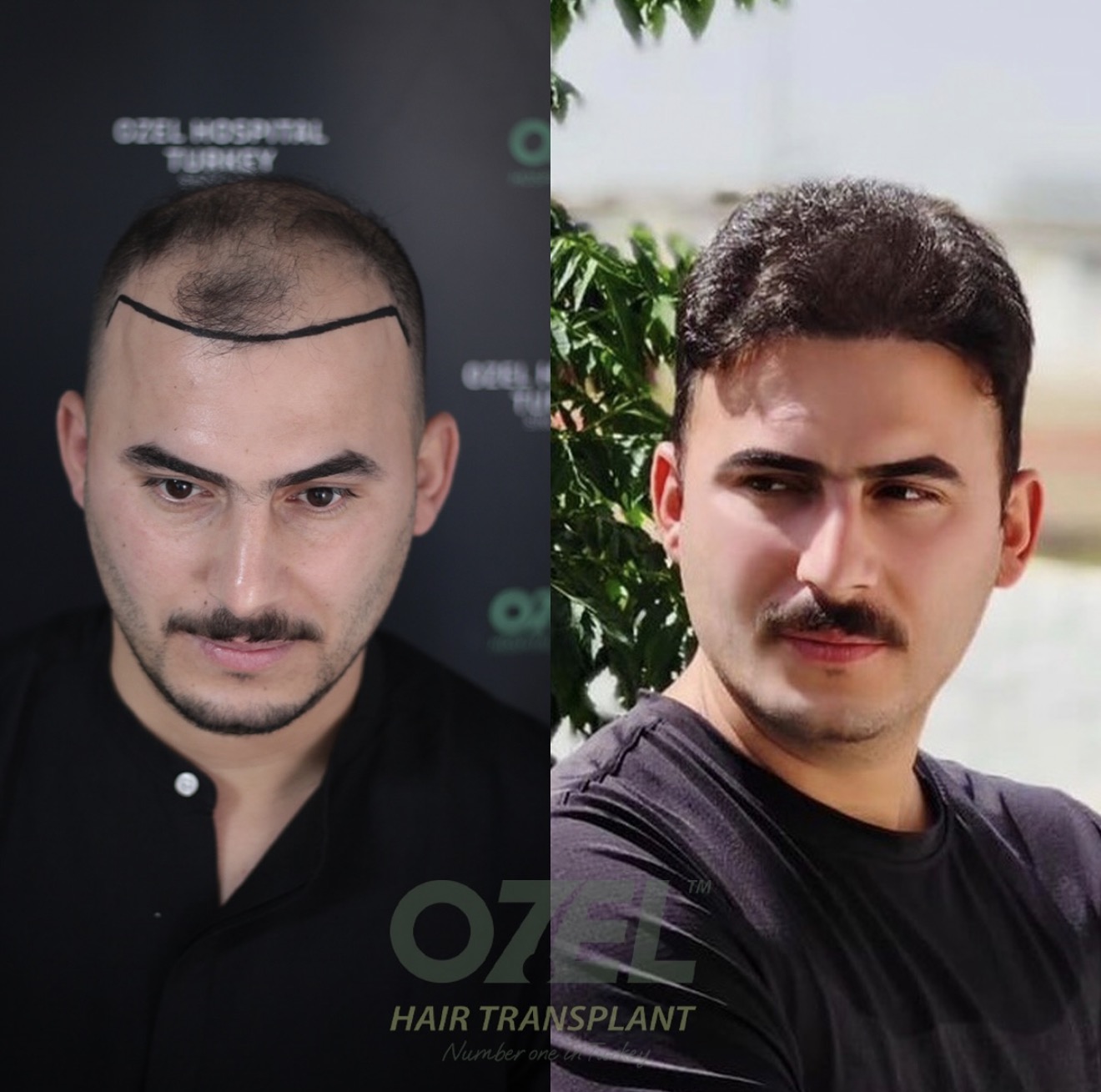 Case 05: before and after hair transplant