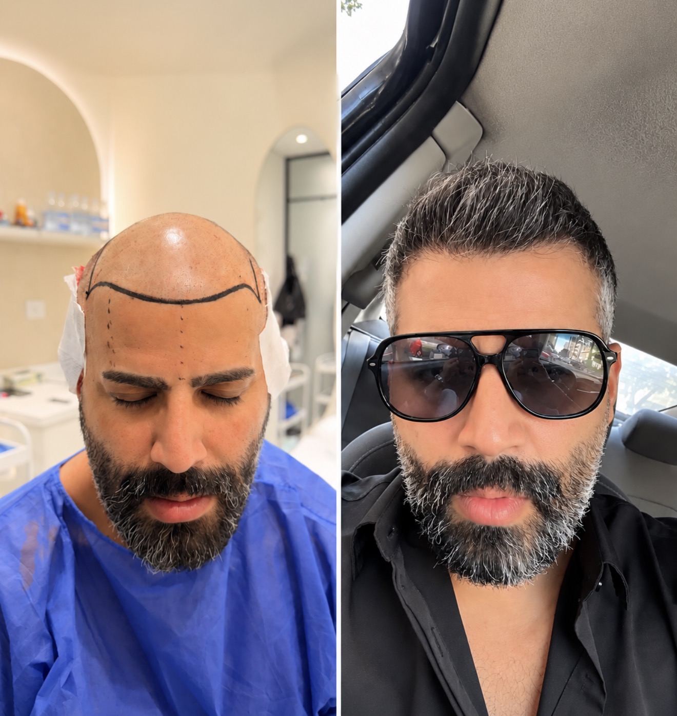 Case 06: before and after hair transplant