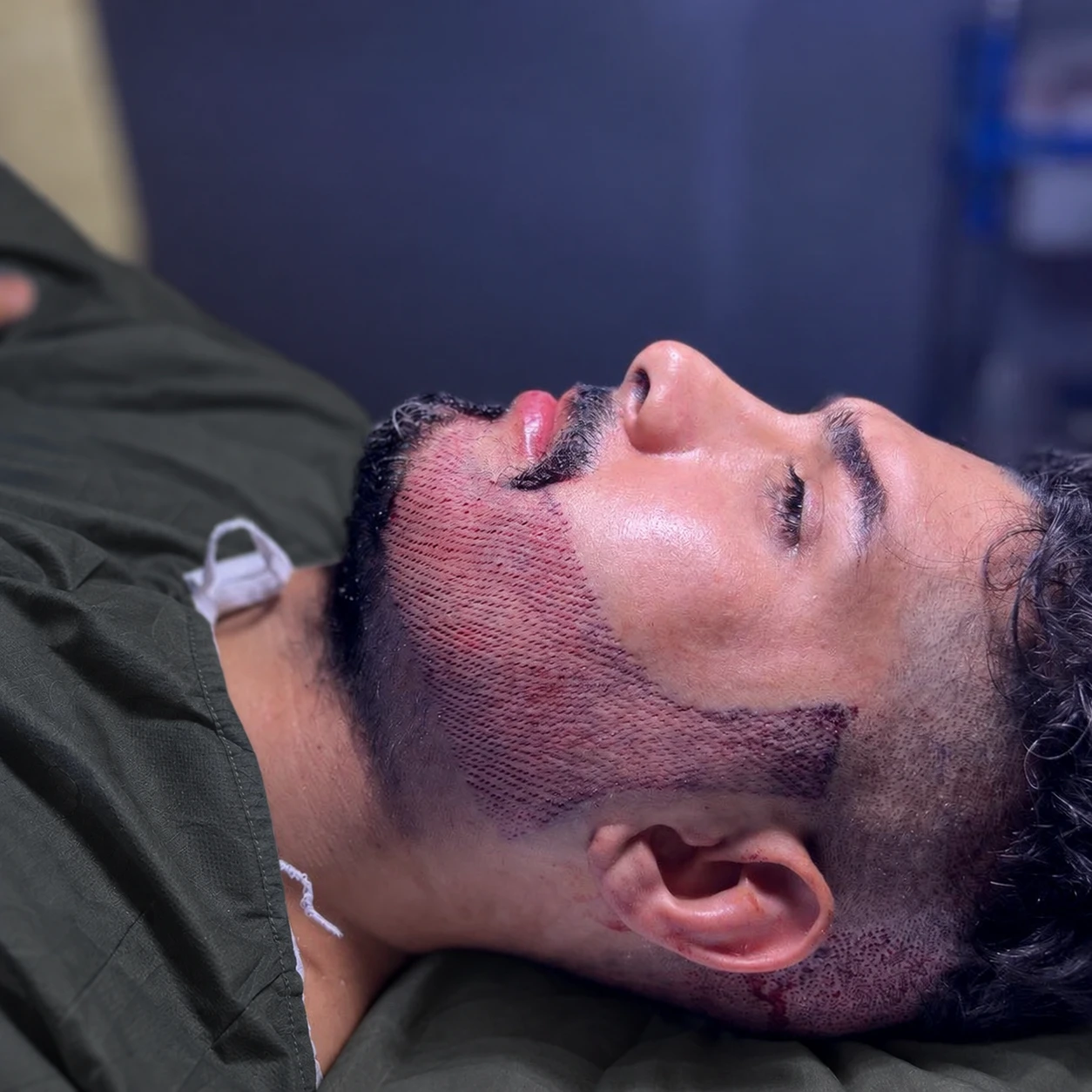 A client after a beard transplant, grafts placed along the cheek and jawline