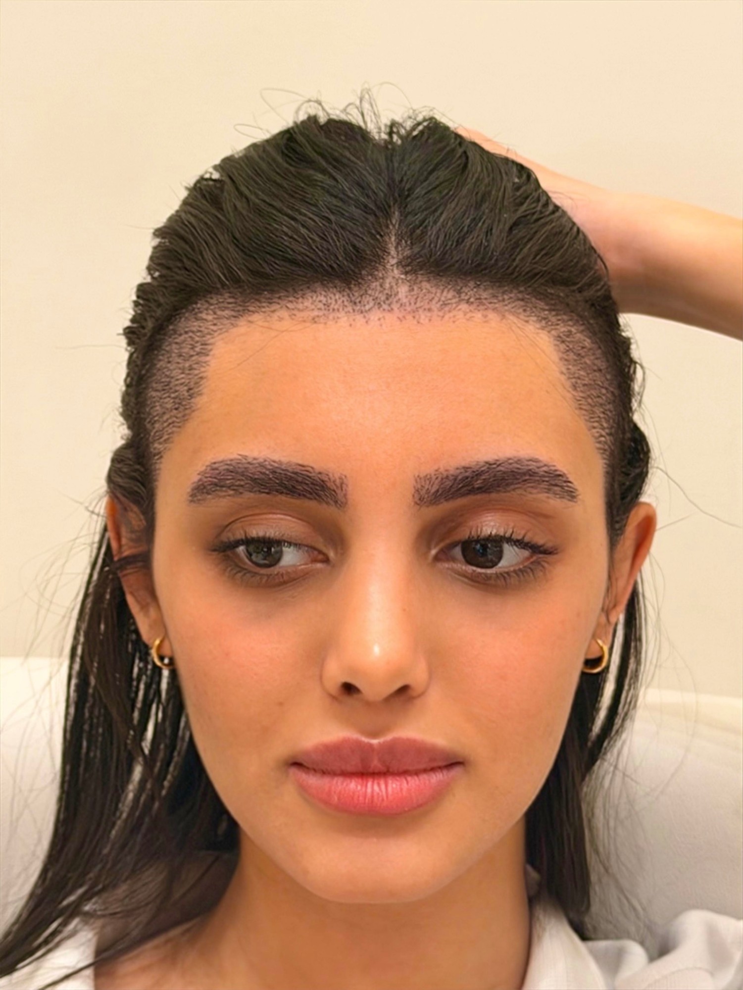 A client after an eyebrow transplant