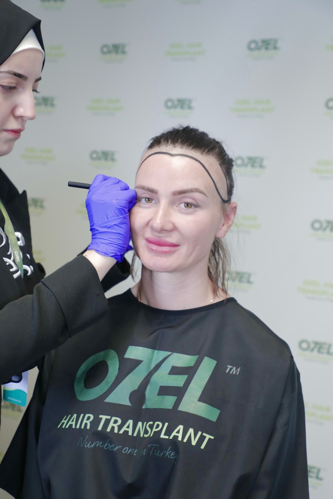 A client with her new hairline drawn before the procedure