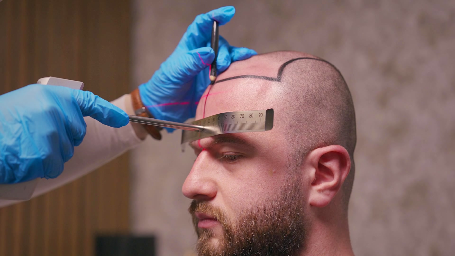 An OZEL doctor measuring a client's new hairline from the brow