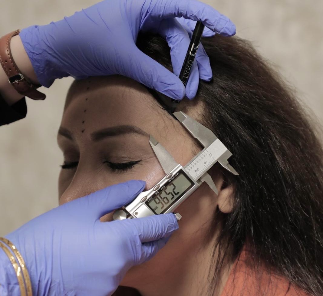 An OZEL specialist measuring a woman’s facial proportions with a digital caliper before hairline lowering
