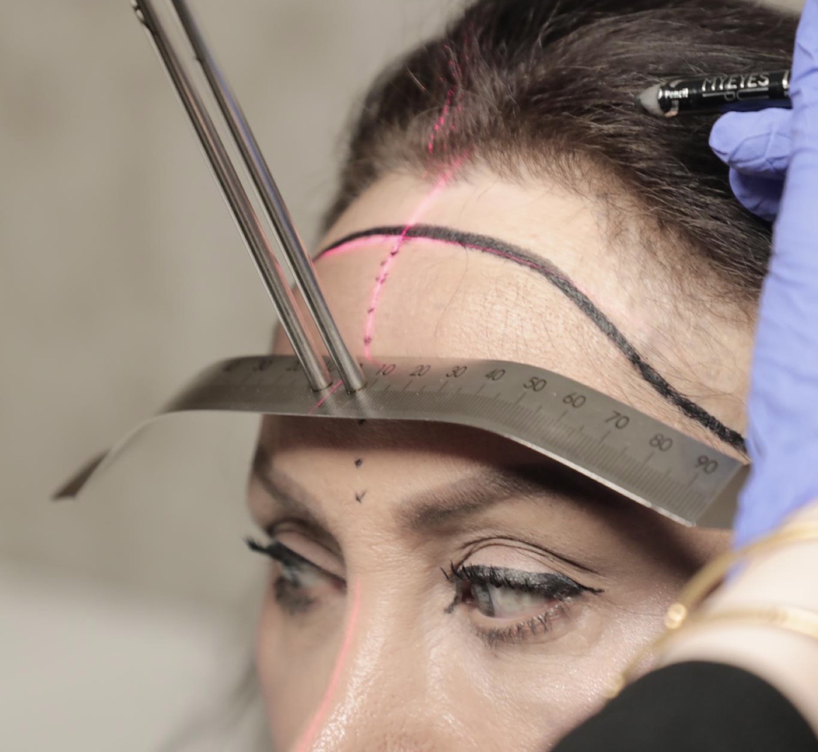 Female hairline design at OZEL: a new, lower hairline measured with a ruler and laser guide for symmetry