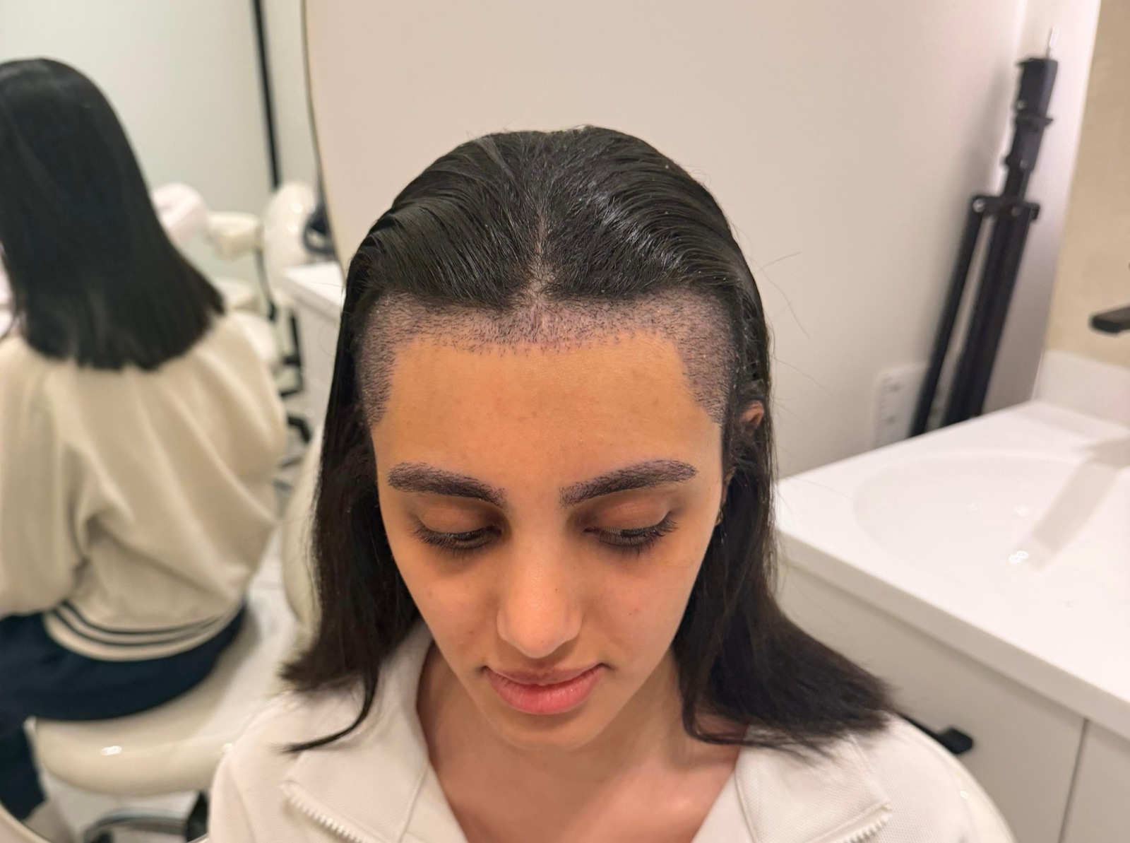 Hairline lowering for a woman right after an unshaven hair transplant at OZEL, with grafts distributed evenly along the new hairline