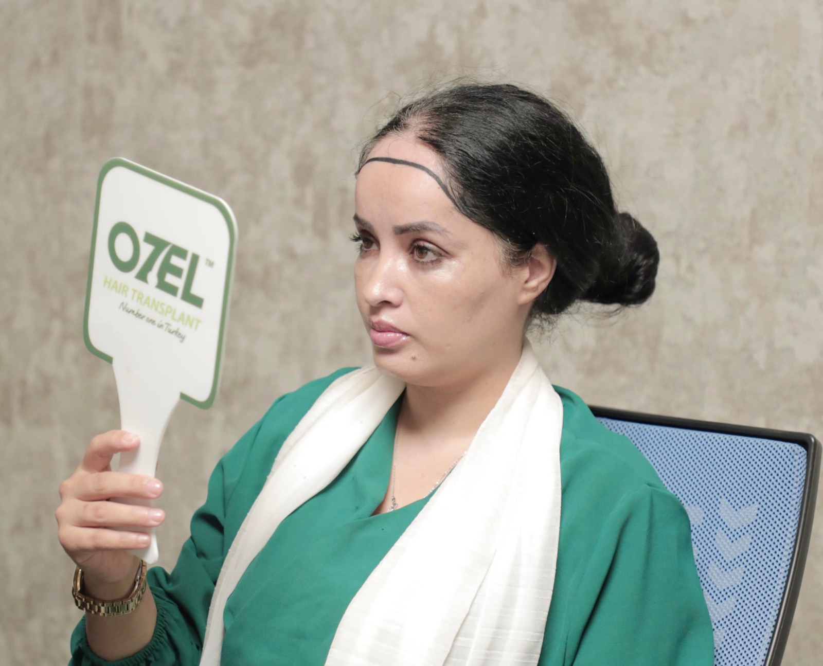 A woman checking her new hairline design in a mirror before an unshaven hair transplant, with her long hair kept